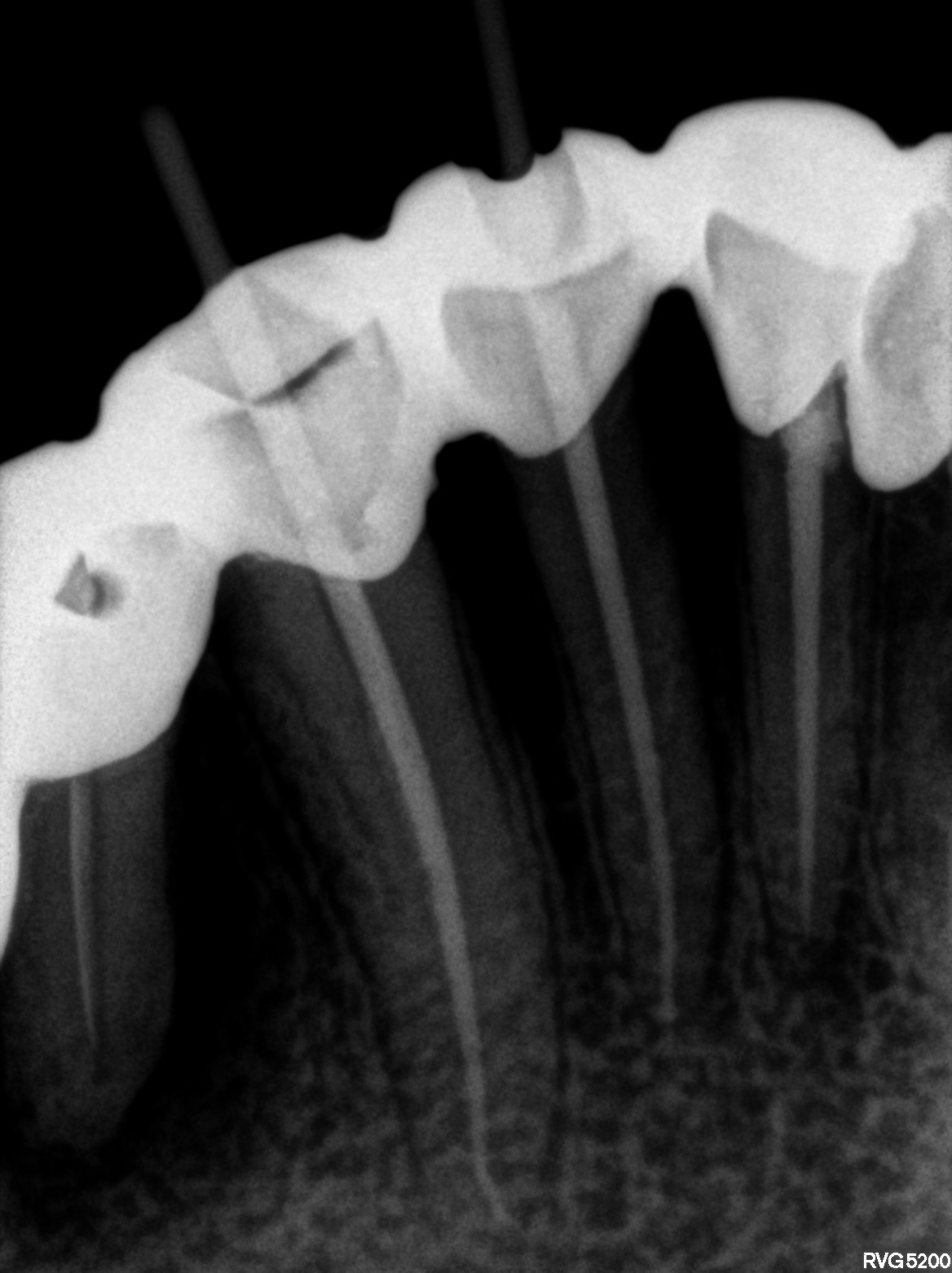 Dental X-ray